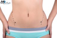 Liposuction