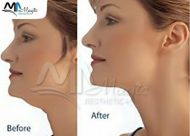 Double chin surgery