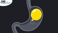 Gastric balloon